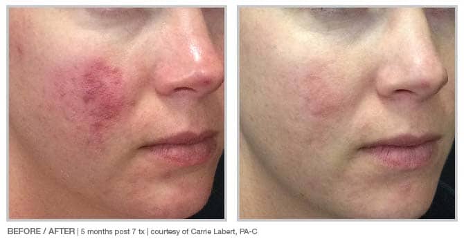 person before and after BBL forever clear treatment, showing acne on cheek disappearing afterwards