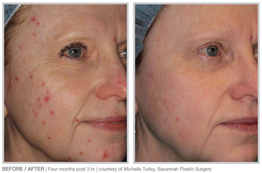 woman before and after BBL Forever Clear light-based acne treatment with much clearer skin after