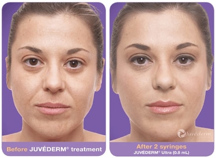 two before and after photographs showing a headshot of a woman with the text Juvederm
