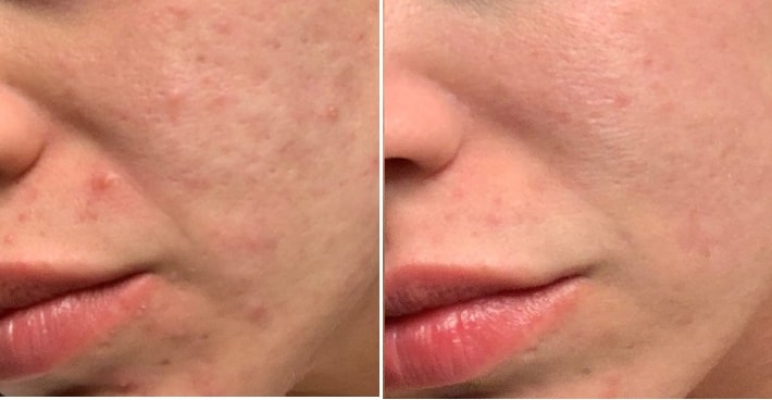 patient’s cheek before and after Morpheus8 skin treatment
