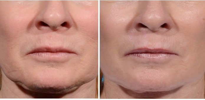 lower half of patient’s face before and after Morpheus8 skin treatment