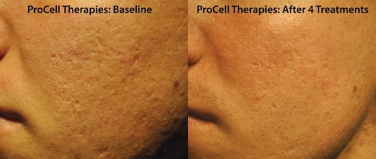 procell acne 550x233 1