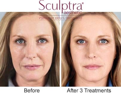 two before and after photos showing headshot of woman with the text Sculptra
