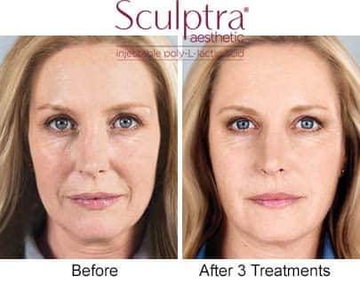 woman before and after Sculptra injections, fewer lines after treatment