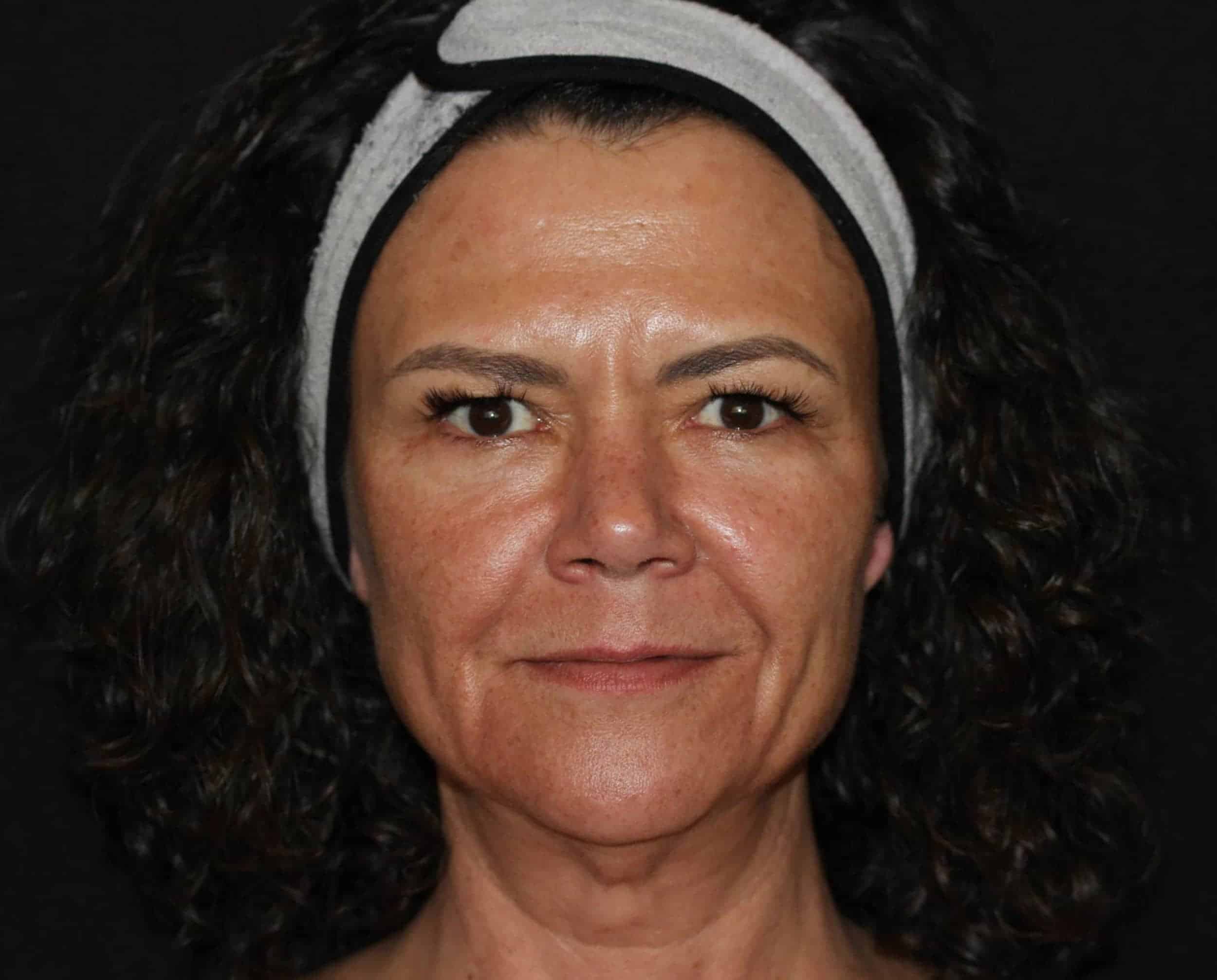 BBL Archives ReDerm MD Medical Spa