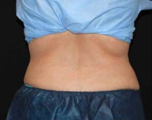 CoolSculpting