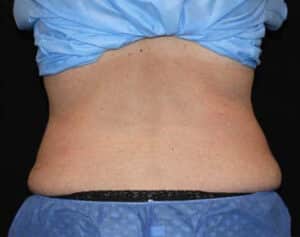 CoolSculpting