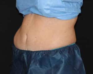 CoolSculpting