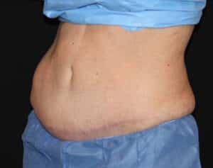 CoolSculpting