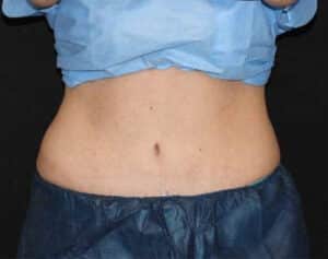 CoolSculpting