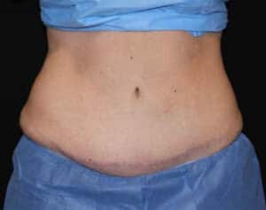 CoolSculpting