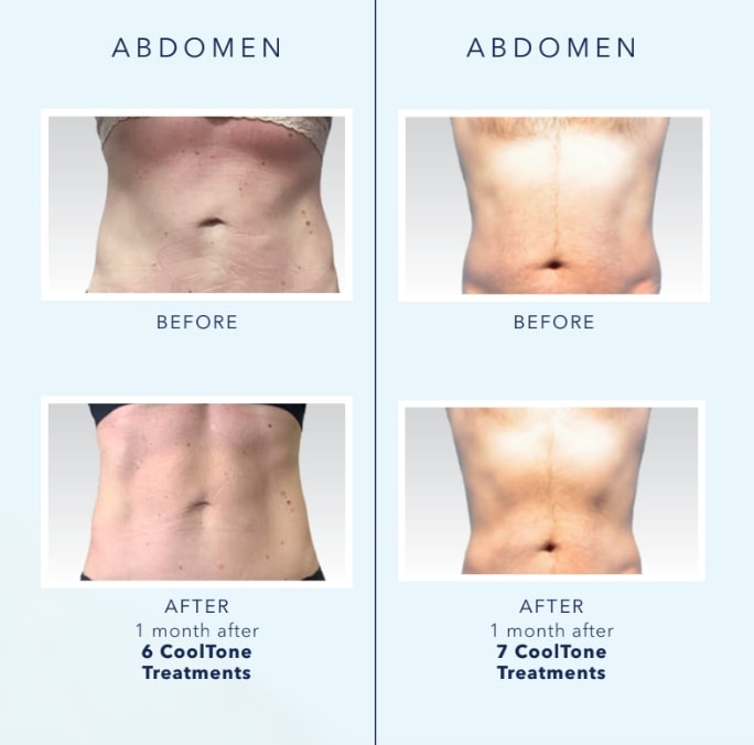 patients’ bare stomachs before and after cooltone body sculpting, flatter and more toned after procedure