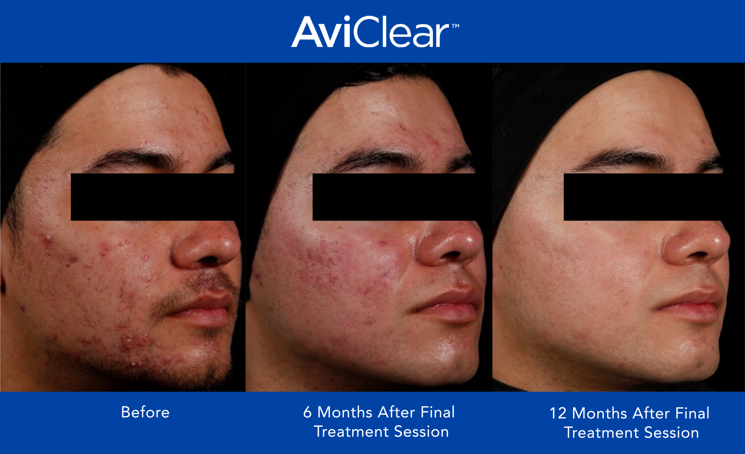 AviClear Before and After 12 month 1