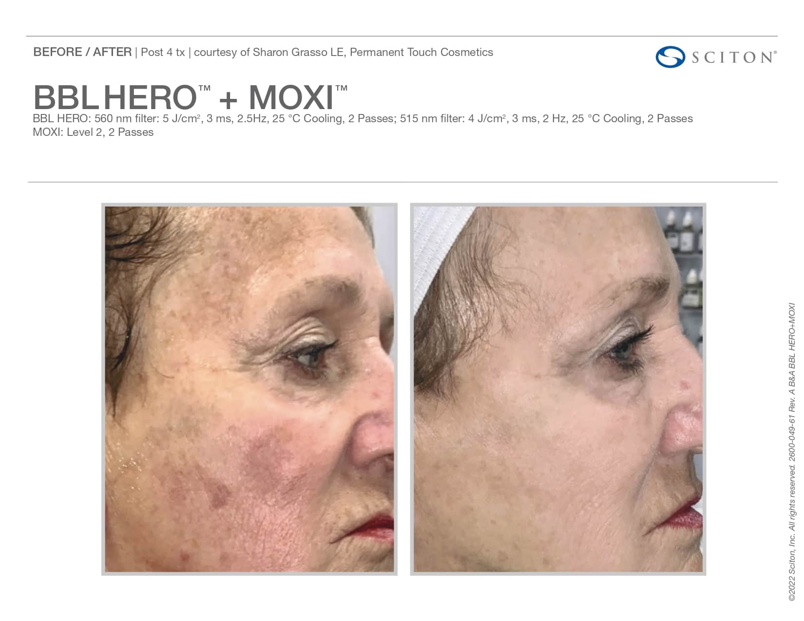 Side of older female patient’s face before and after BBL HERO and MOXI skin treatments, skin clearer after