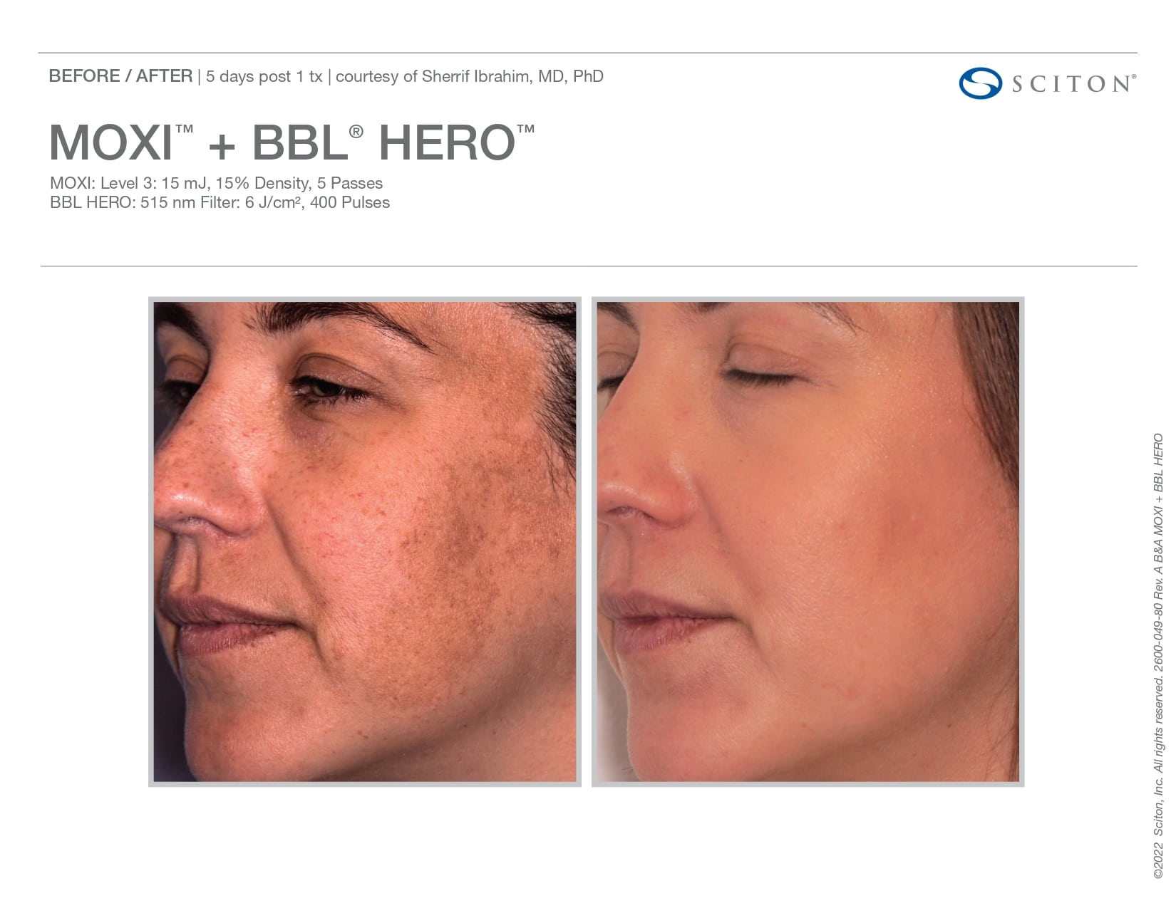 female patient’s cheek before and after BBL and MOXI laser treatments, skin clearer, less discolored after