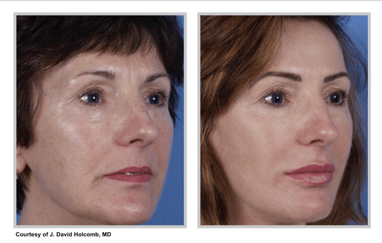 arctic laser peel treatment results female1 denver CO