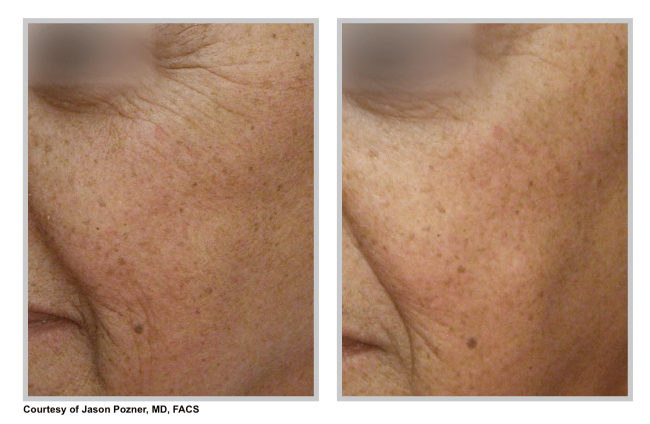arctic laser peel treatment before after denver CO