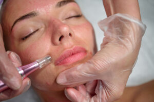 Woman getting SkinPen microneedling in Denver